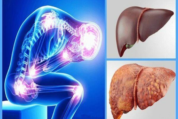 پژوهشگران مطرح کردند :اصلاح سبک زندگی، کلید غلبه بر کبد چرب