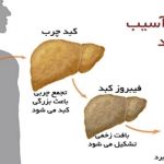 علت کبد چرب /۴۰ درصد افراد بالای ۴۰ سال کشور کبد چرب دارند
