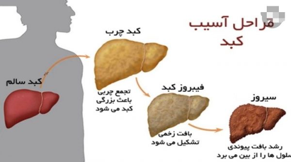 علت کبد چرب /۴۰ درصد افراد بالای ۴۰ سال کشور کبد چرب دارند